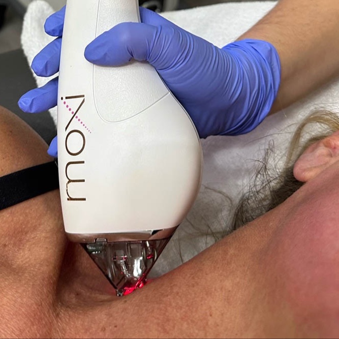 Moxi Laser Face/Neck/Chest at The Skin Concierge in Northbrook, IL