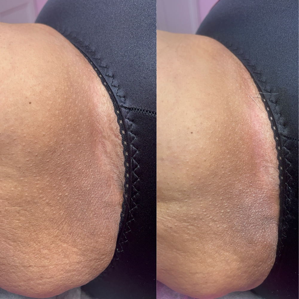 Inner Thighs Skin Correction