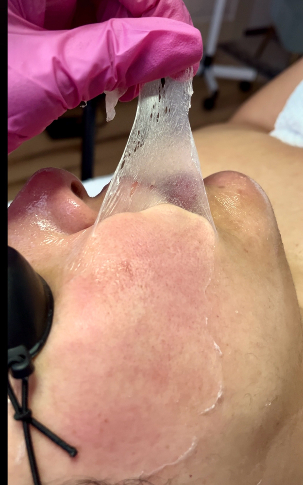 Chemical Peel  Facia- 20%, 30%, 40%