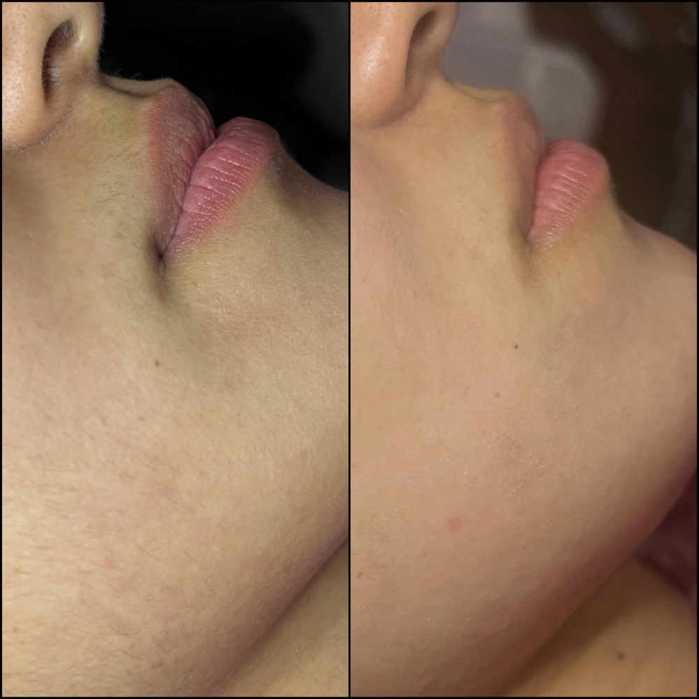 Dermaplane Facial