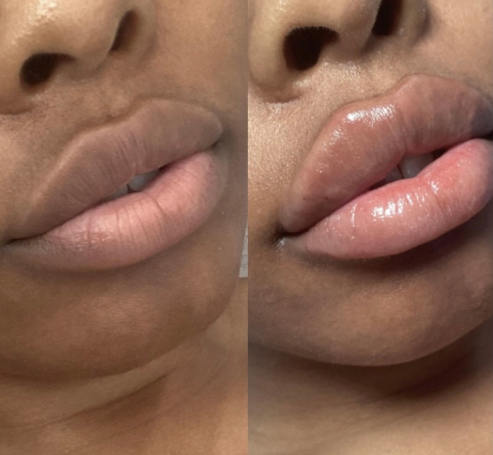 PRETTY & PLUMP LIP FILLERS ~ 1 ML