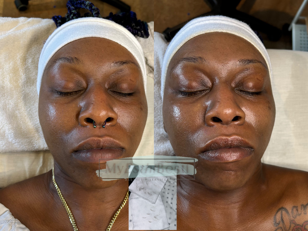 Dermaplane Facial