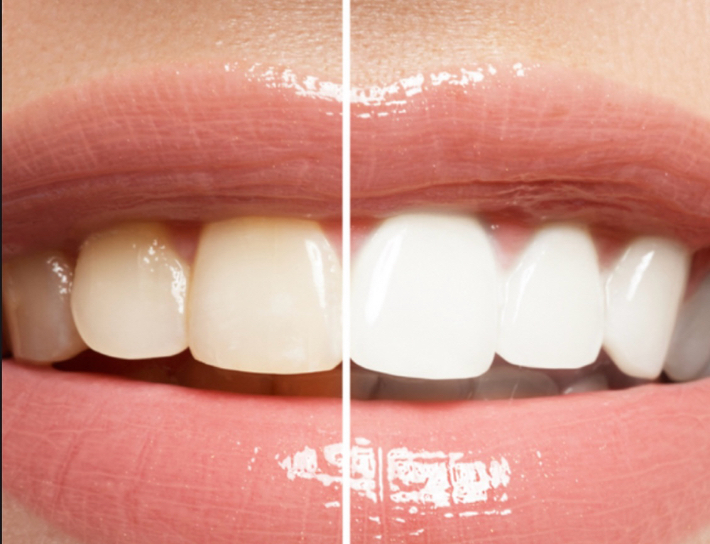 Professional Teeth Whitening