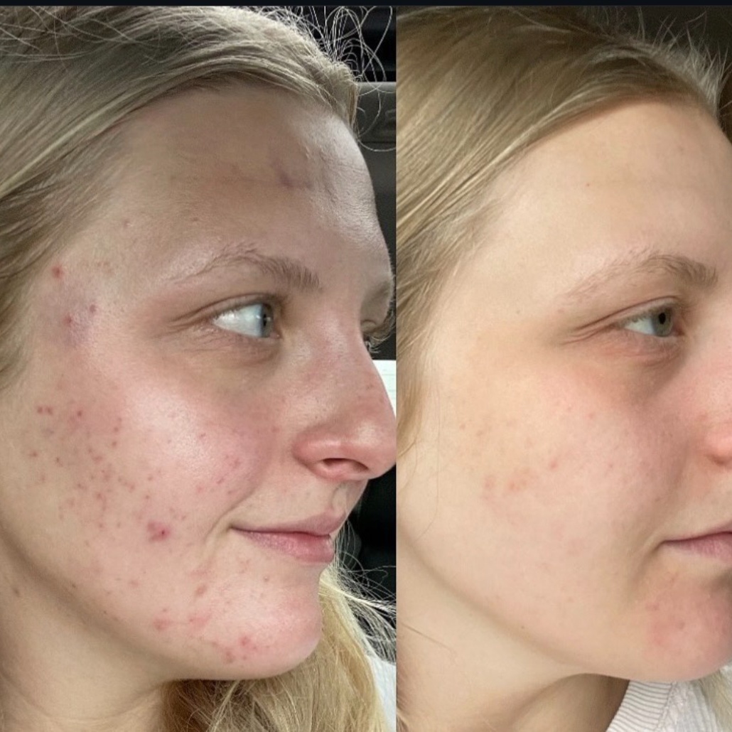 Bi-Weekly Acne Treatments at Aura Haus in Owensboro, KY