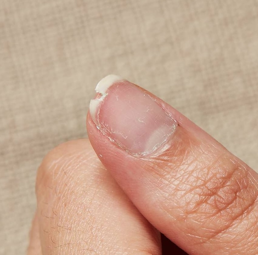 Cracked Nail Fix