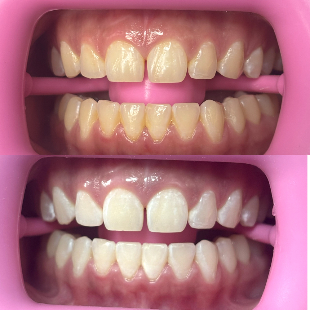 Teeth Whitening (60 Min Session)