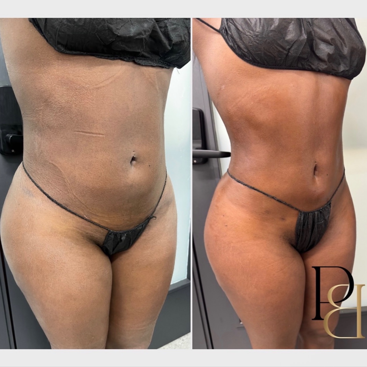 Lymphatic Massage at Pleasures of Beautee in Atlanta, GA