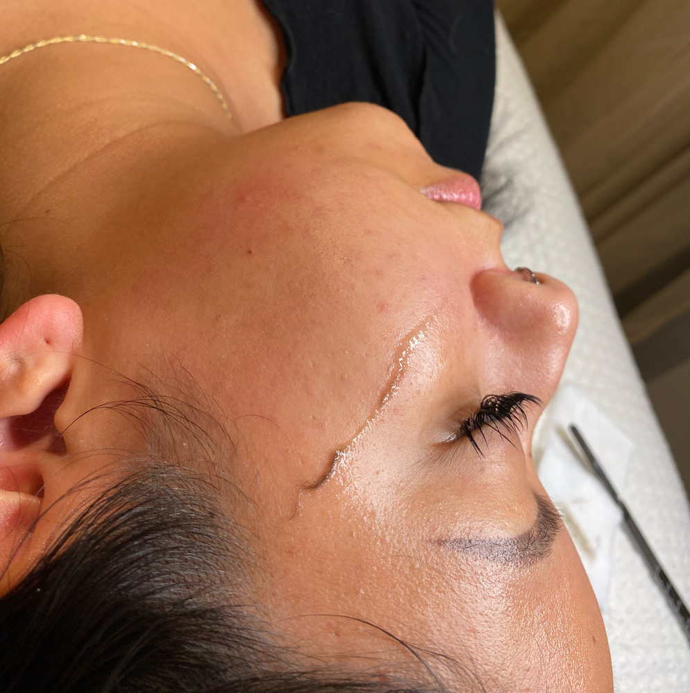 Dermaplaning