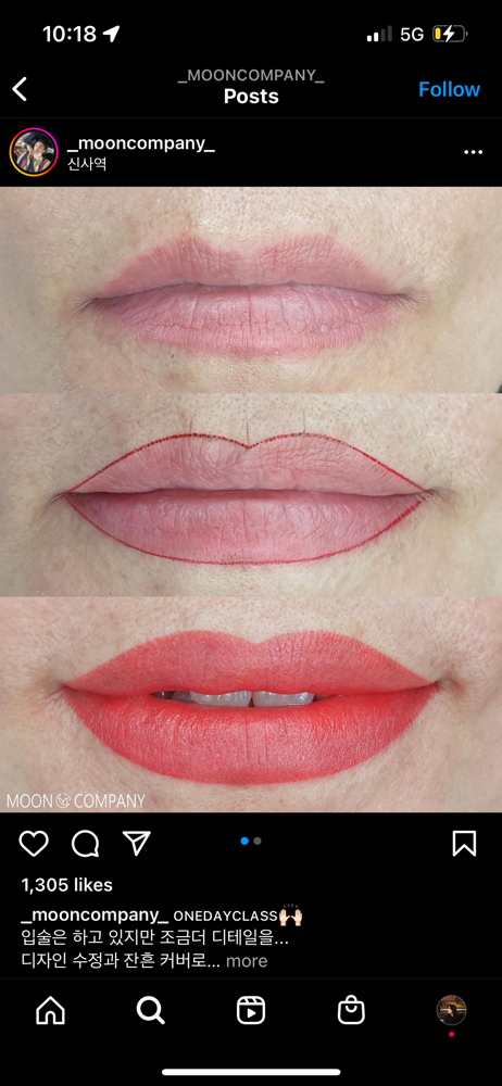 Retoque labios- 4 semanas