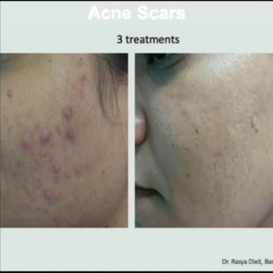 Tixel Scar & Acne Treatment at Marco Island Aesthetics