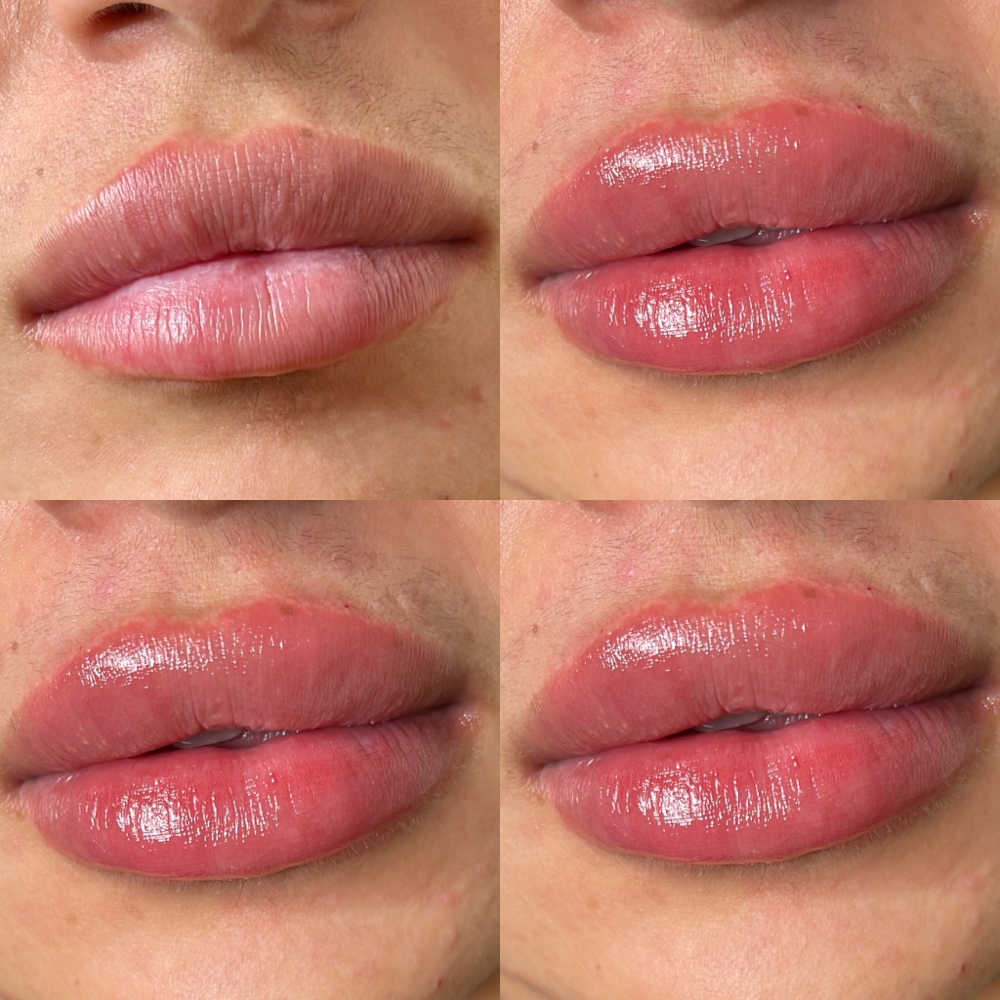 HA Full Syringe Lip Filler