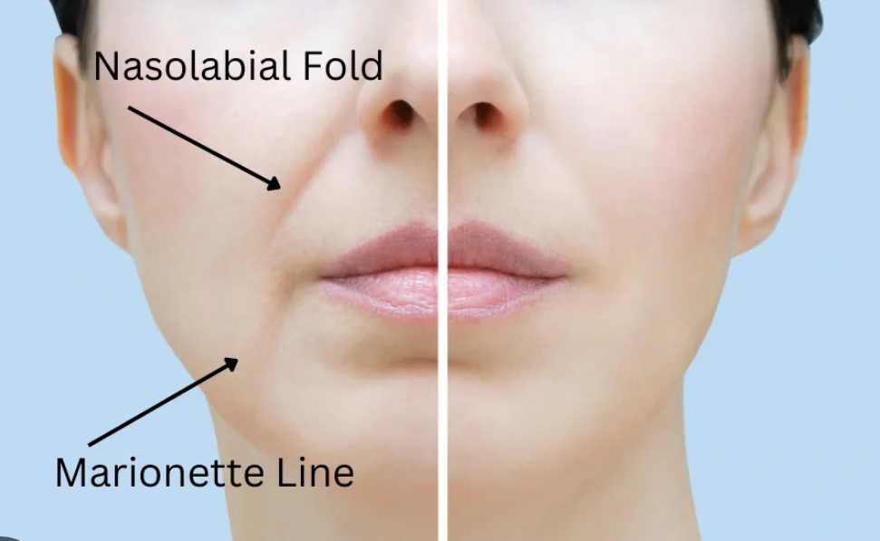 Filler:Smile Lines/Jowel Correction