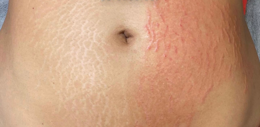 Inkless Stretch Mark Revision