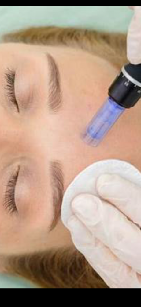 Microneedling