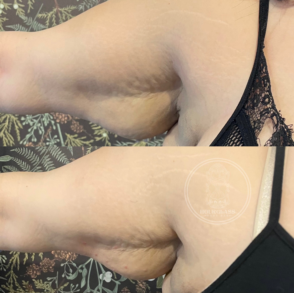Arms Fat Dissolve