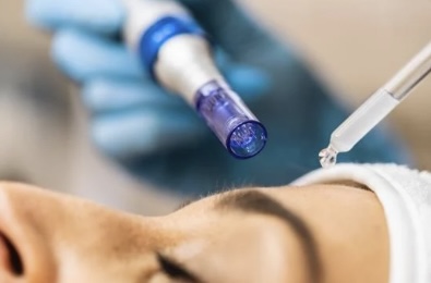 Microneedeling