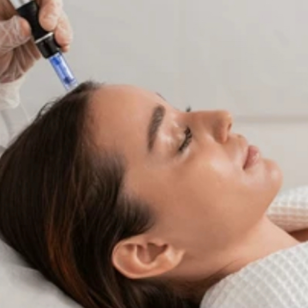 Stand Alone Scalp Microneedling at Vibe Skin Lab in Woburn, MA