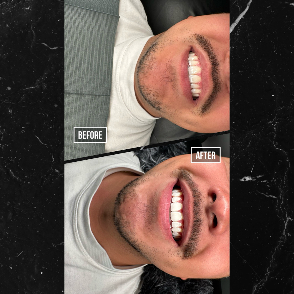 75 Minute Teeth Whitening