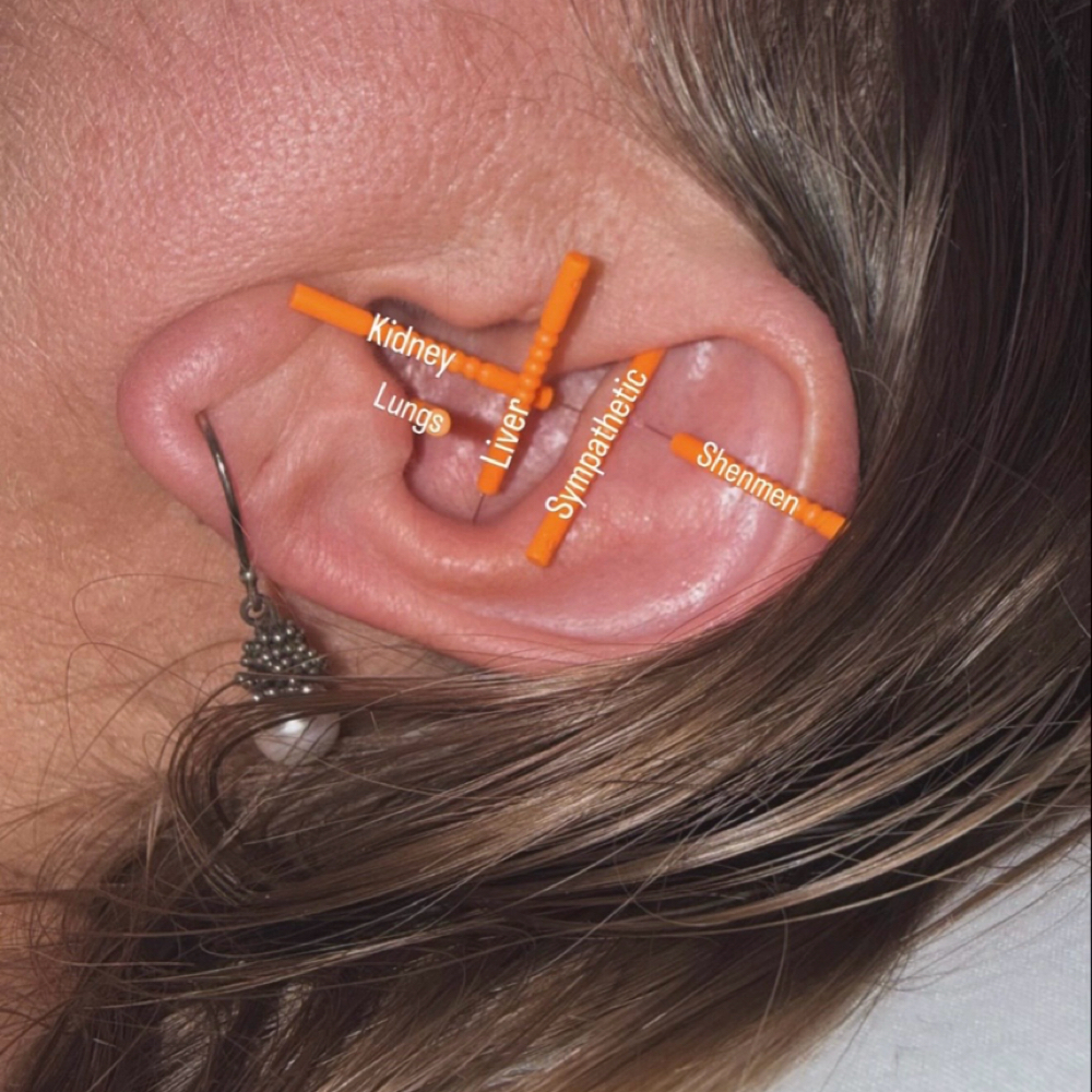 Ear Detox Acupuncture Session at Relaxing Rose Therapeutic Massage in Lincoln Park, MI