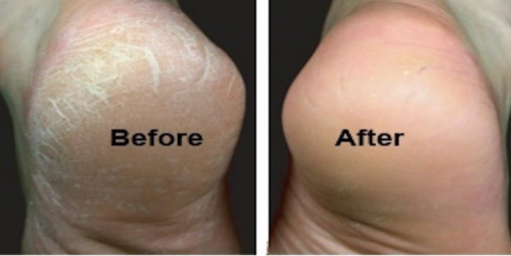 Medical Severe dry Cracked Heels
