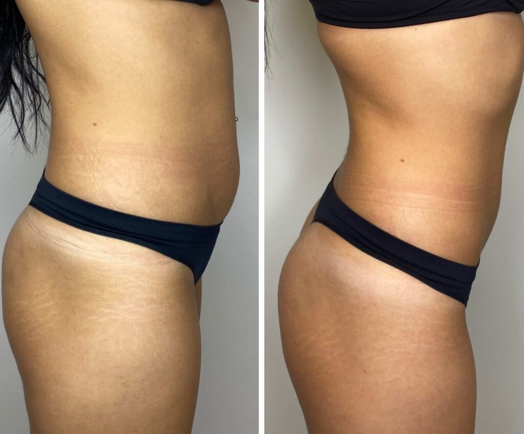 Combo (3) Session (Cavitation + RF)