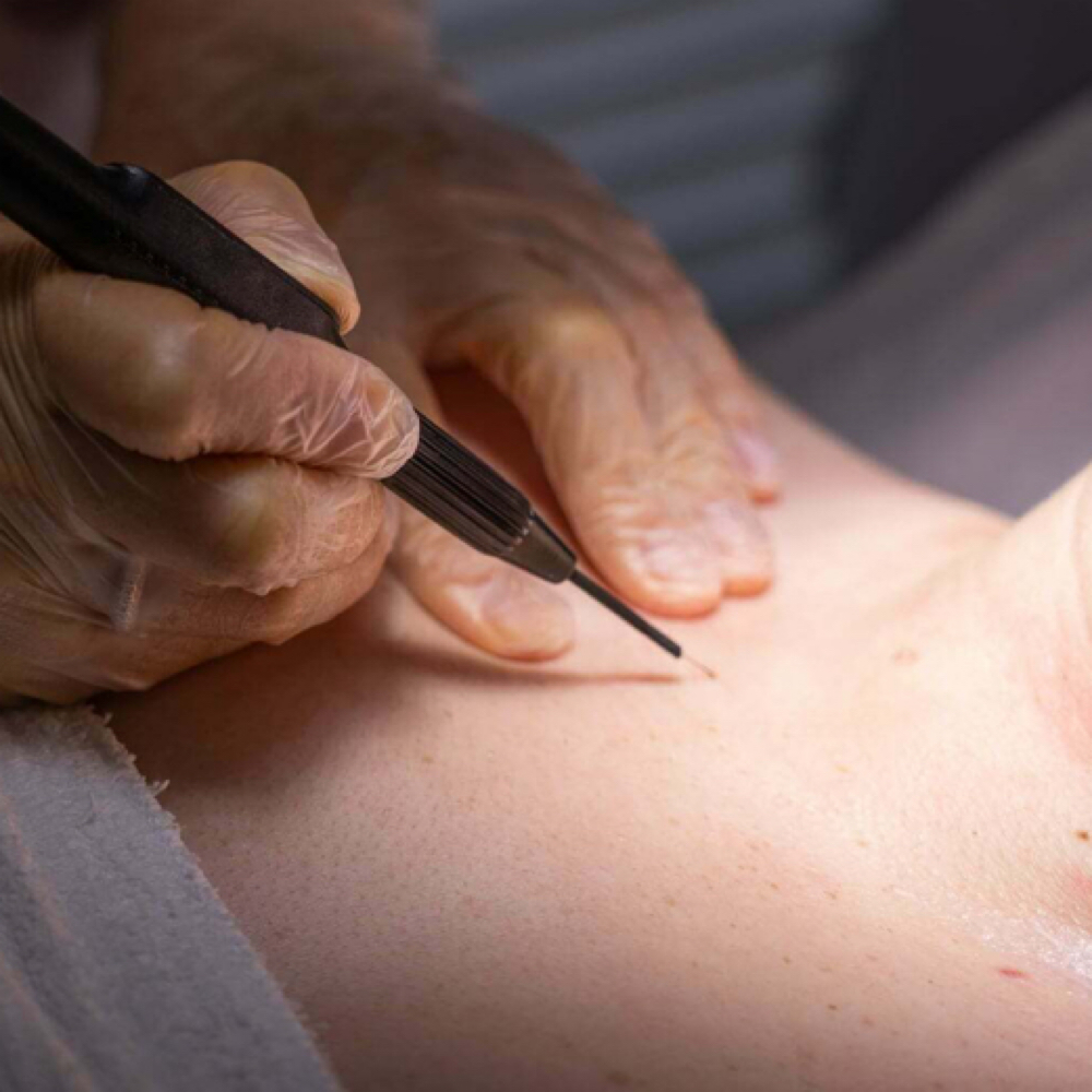 Skin Tag Removal at Aesthetik Nurse Kat in Riverside, CA
