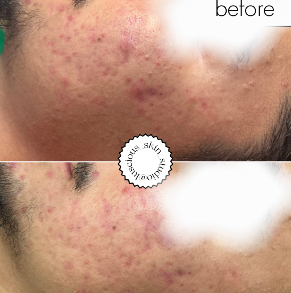 PDT Acne Clarifying Treatment at Luscious Skin in Salinas, CA