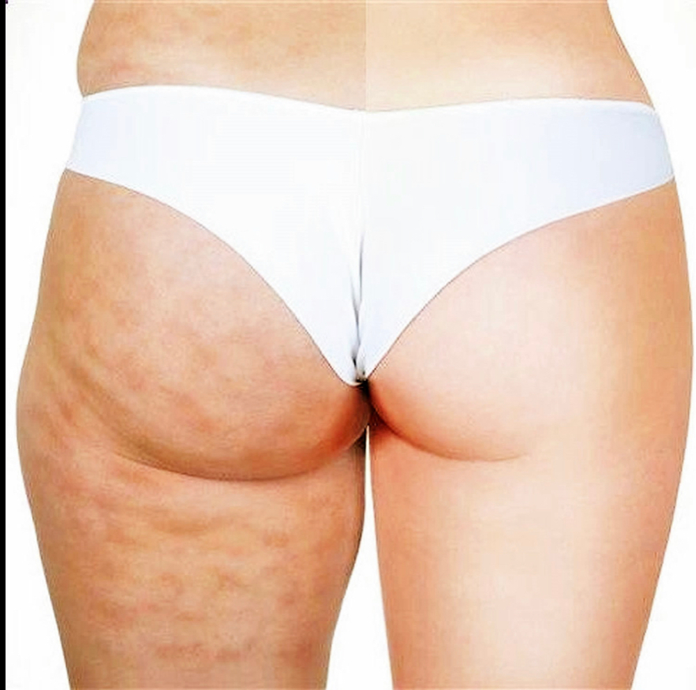 Shilo Sculpt Cellulite Custom TX