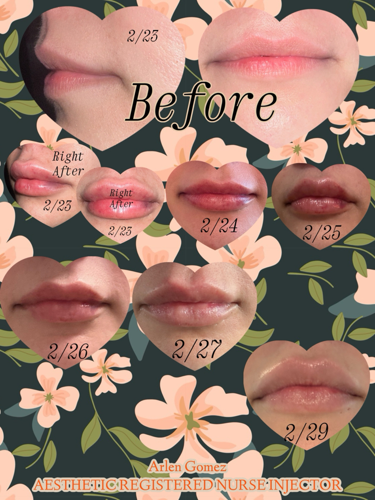 Lip Filler