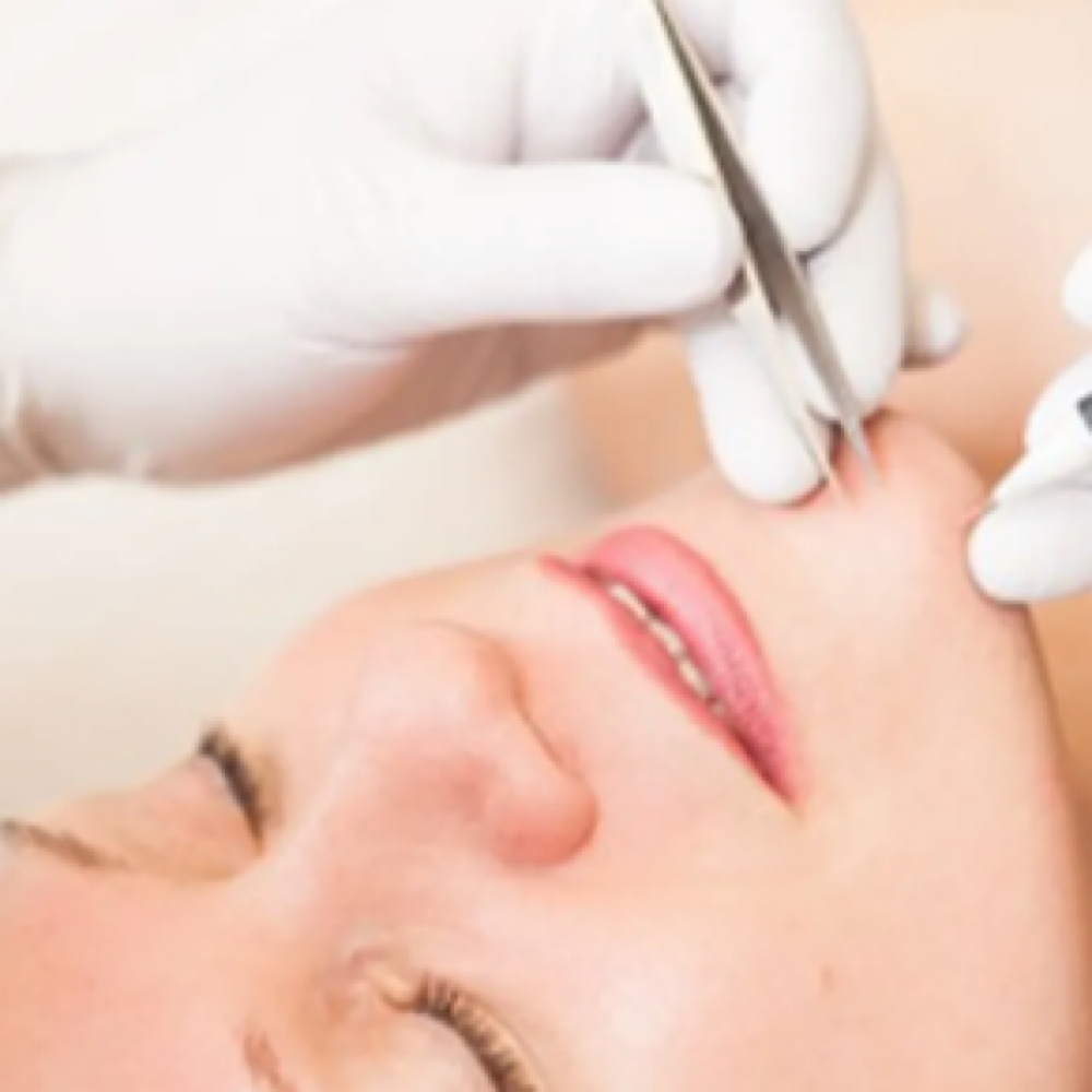 Electrolysis at Aura Electrolysis | Laser | Threading in Ashland, MA
