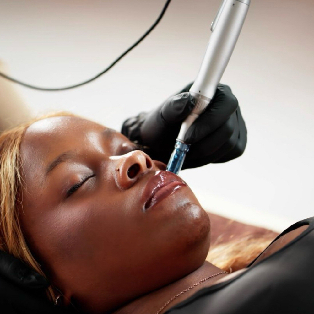 Microneedling With HA at Cherished Aesthetics in Snellville, GA