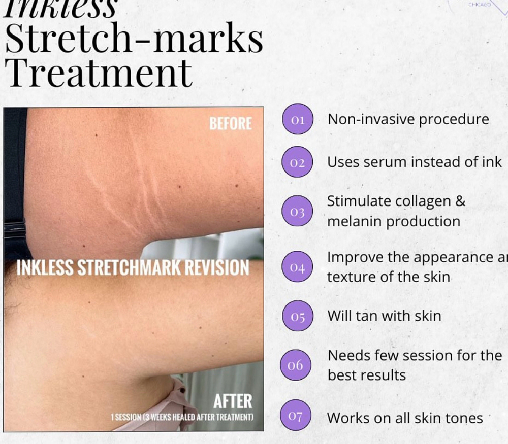 Stretch Mark Repair  Inkless Serum