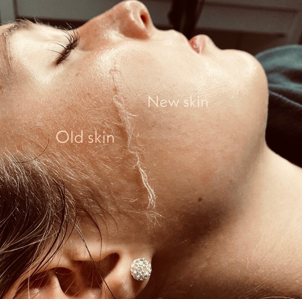 Peach 🍑D-Fuzz Facial