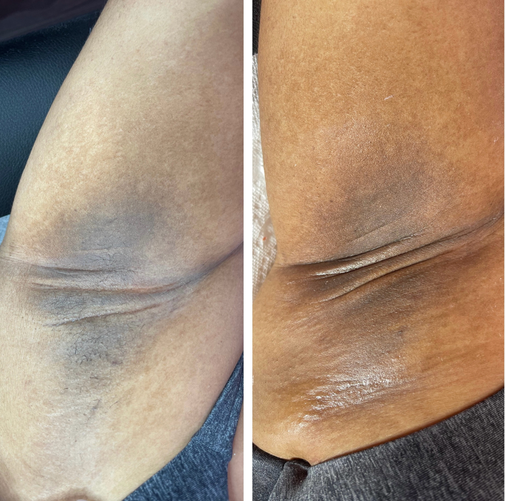 SPA Glow Underarm Treatment + Wax *Brightening