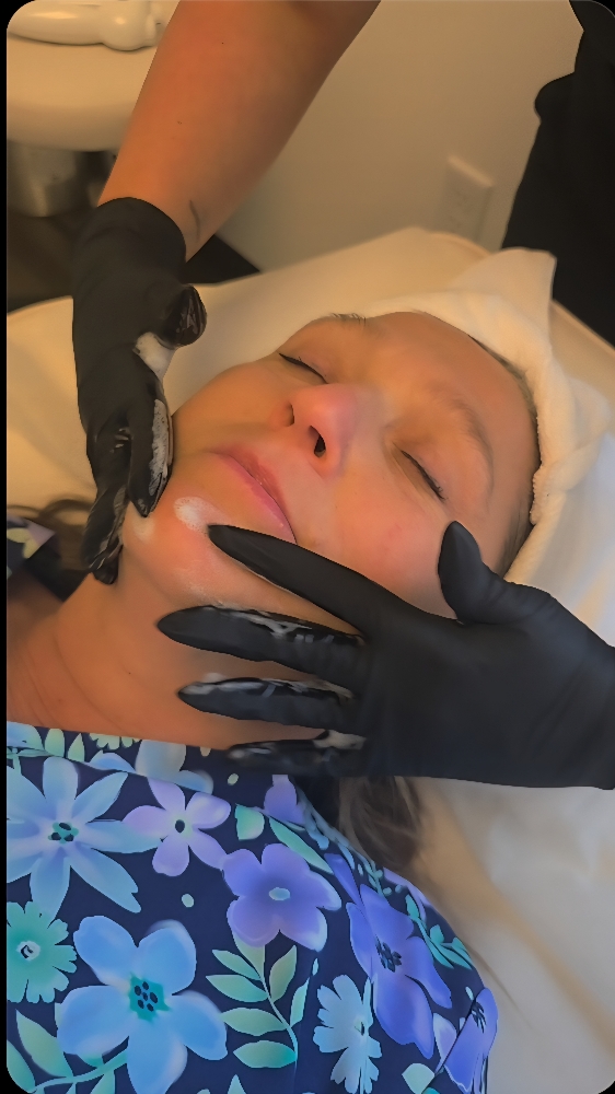 Facial Frotox Treatment