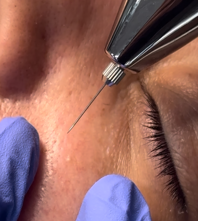 Skin Tag/Mole/Keratosis Removal