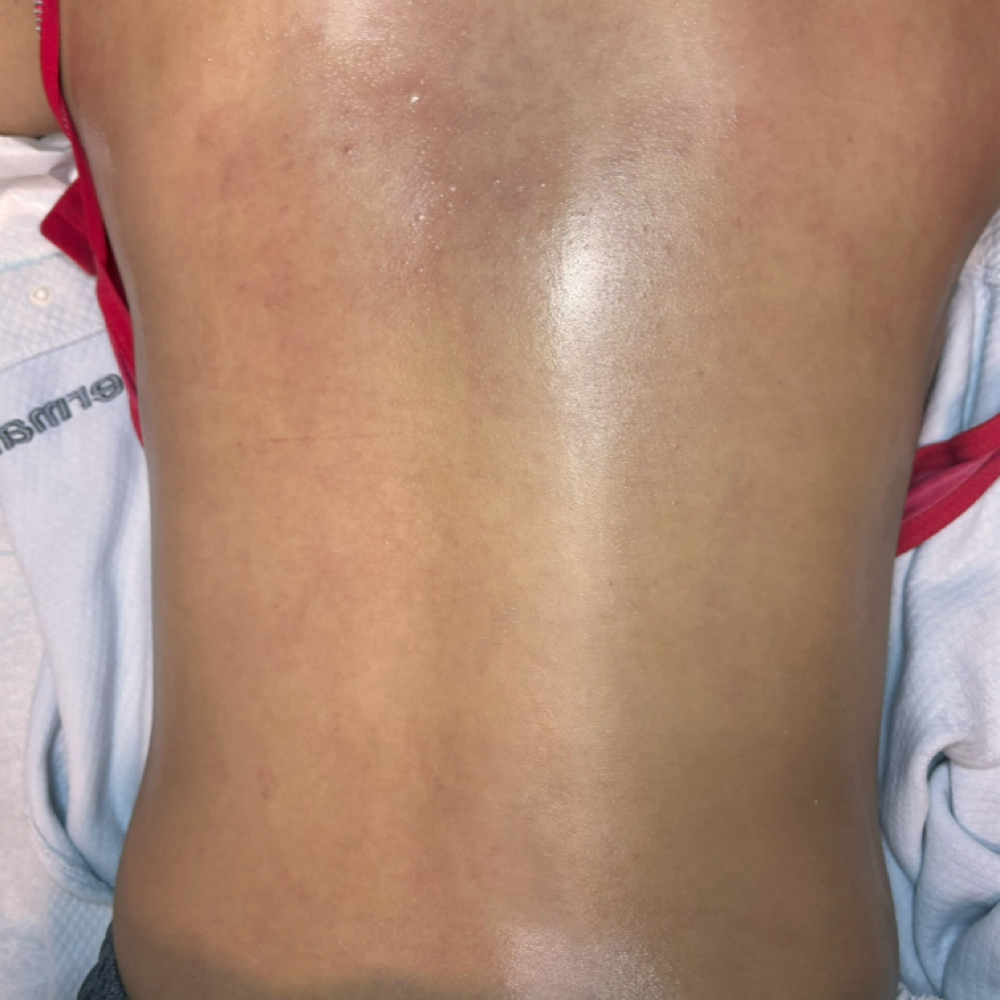 Full Back Wax at Pearly Derm in Sun valley, CA