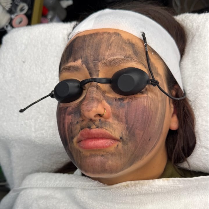 Hollywood Peel at Windys Beauty Studio LLC in Virginia Beach, VA