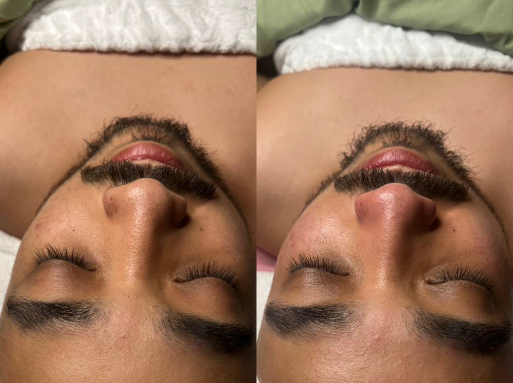 Microdermabrasion Treatment