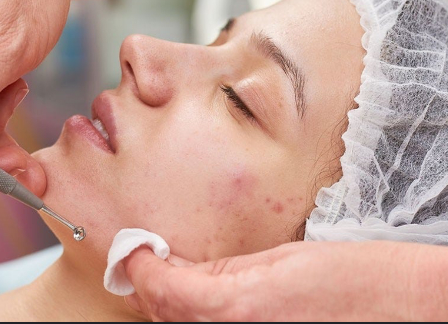 Adult acne Facial