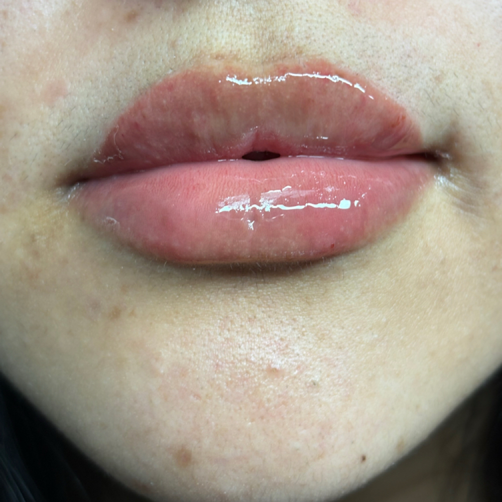 Juvederm Lip Filler 💉 at Domain Lips N Lashes in Corpus Christi, TX