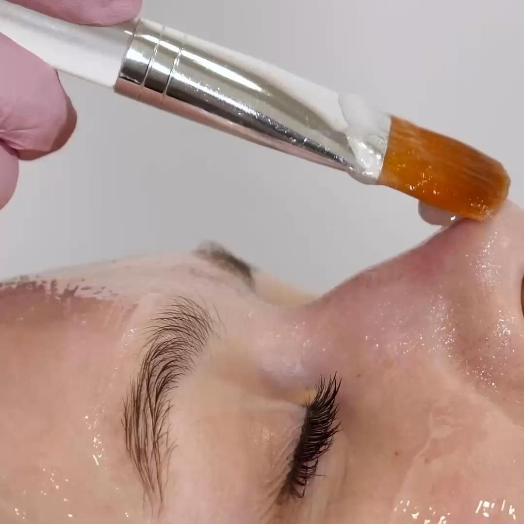ACNE PEEL at Remake Beauty Studio Mission in Mission, TX