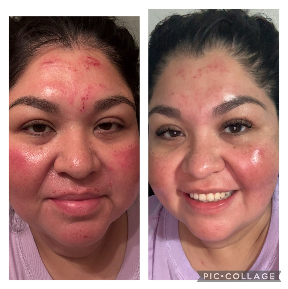 Peel With Microneedling
