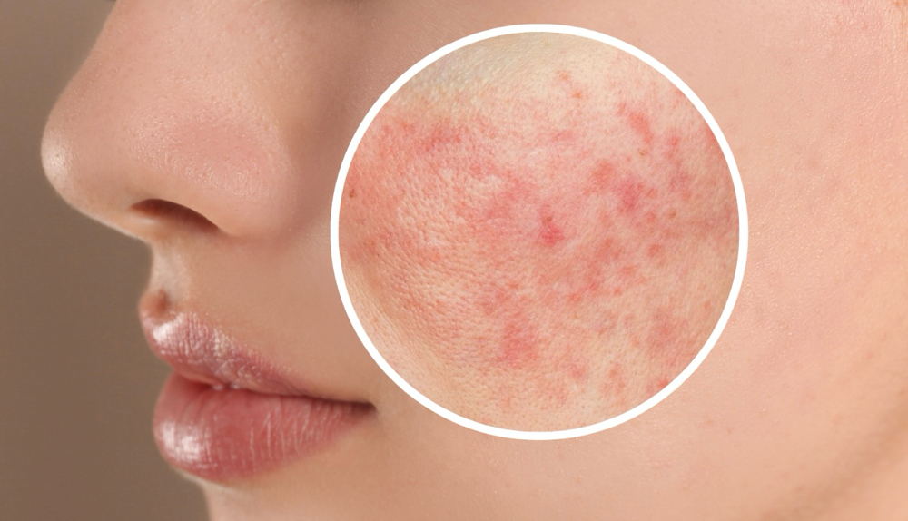 The Rosacea Calming Facial