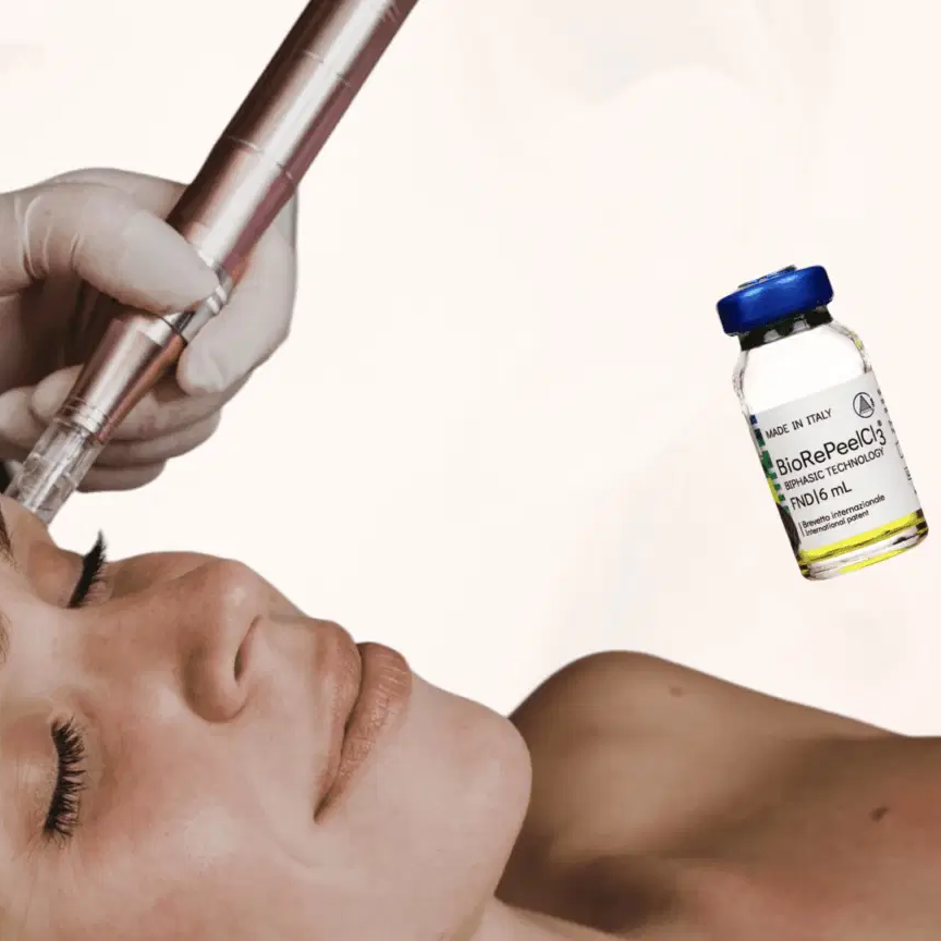 Microneedling X BioRePeel at Esthetic By Val in Clinton Township, MI