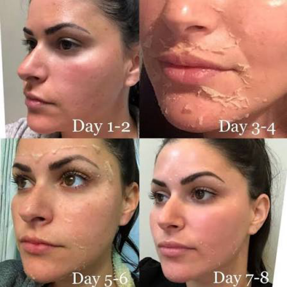 VI Peel® Chemical Peel at SKIN CLINIC GUINOT PARIS in Laguna Hills, CA
