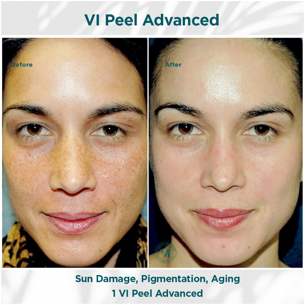 VI Peel® Chemical Peel at SKIN CLINIC in Laguna Hills, CA