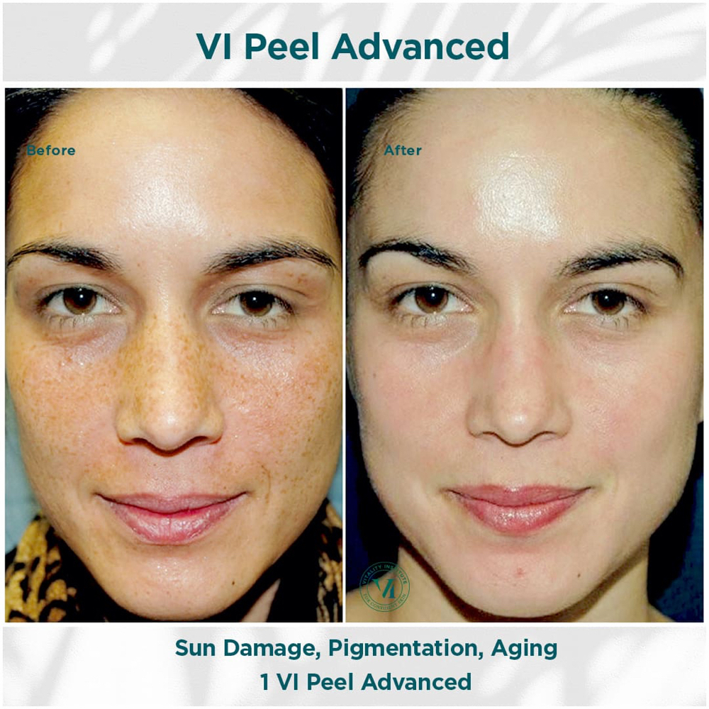 VI Peel® Chemical Peel at SKIN CLINIC in Laguna Hills, CA