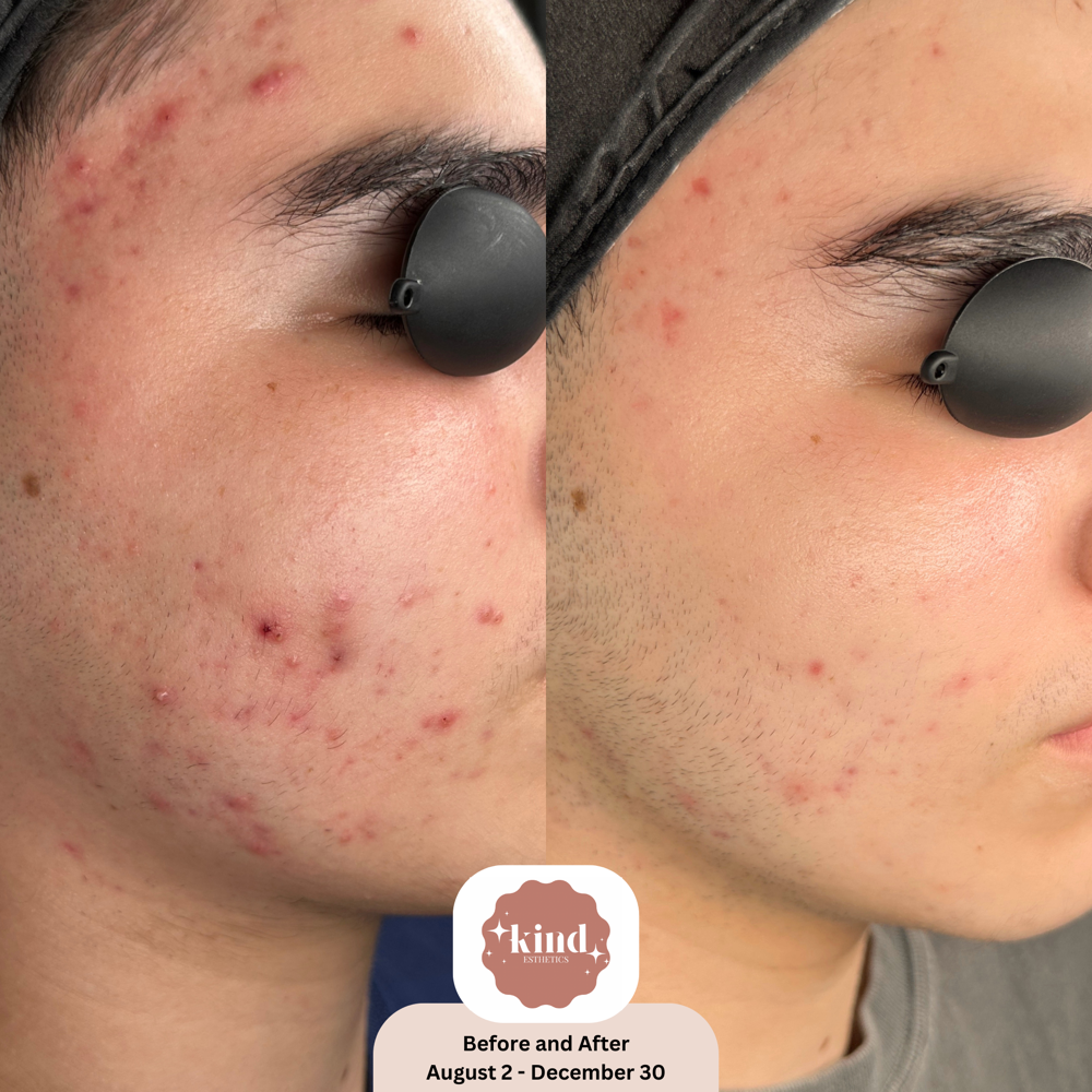 Virtual Acne Program