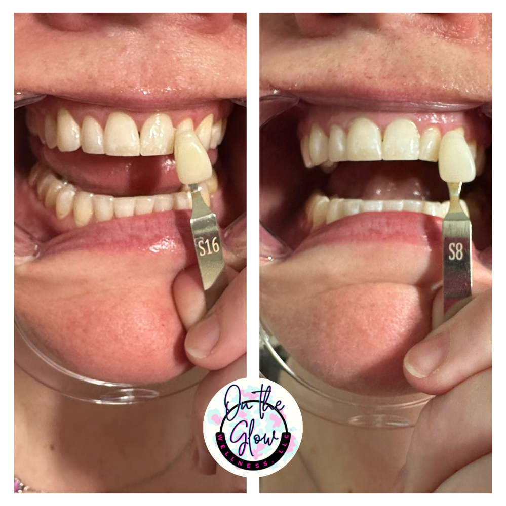 Polished Teeth Whitening